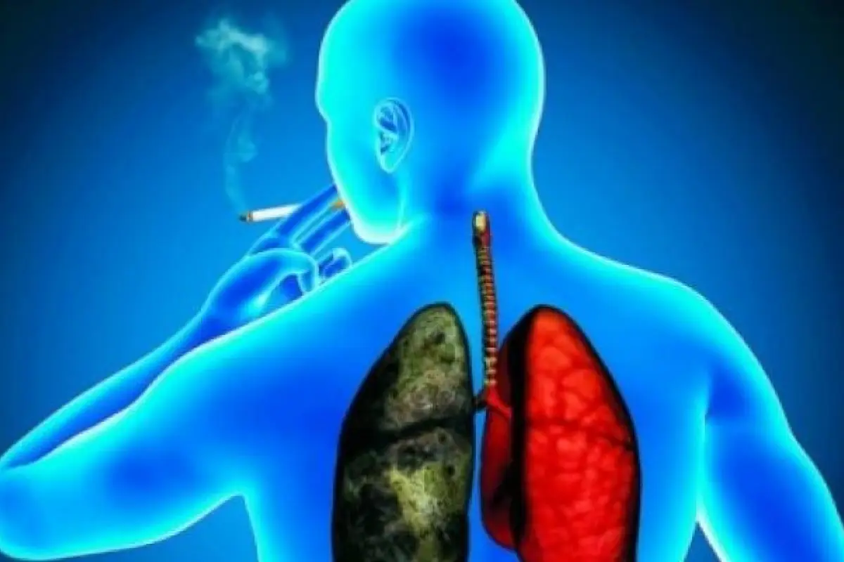 CANCER DE PULMON, 