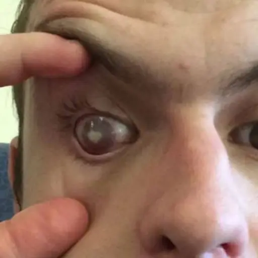 nicky ojo parásito ,