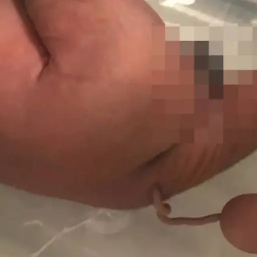  Foto: Journal of Pediatric Surgery Case Reports