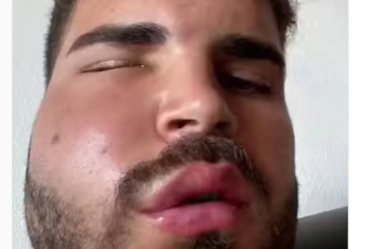 Youtuber muestra cómo se le deformó el rostro durante viaje en México, 