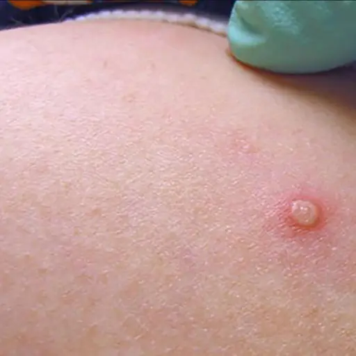 Salud confirma once casos de viruela del mono en Guatemala ,