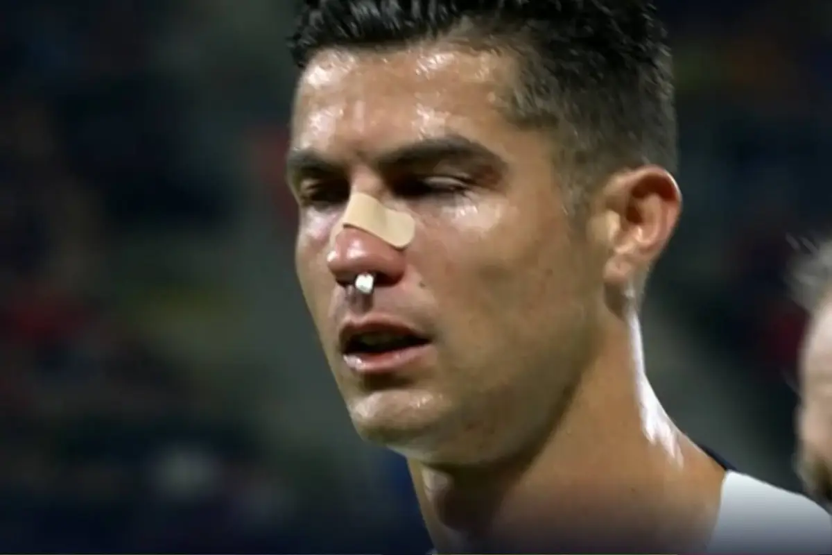 Cristiano Ronaldo golpe nariz, 