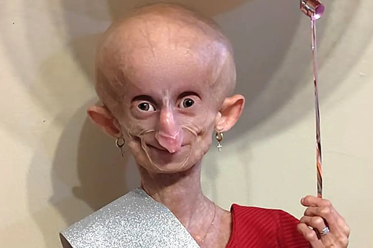 ¿Qué es la Progeria? Enfermedad que padecía la tiktoker Beandri Booysen, Redes sociales