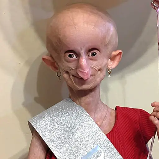 ¿Qué es la Progeria? Enfermedad que padecía la tiktoker Beandri Booysen ,Redes sociales