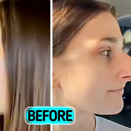 rinoplastia ,Instagram