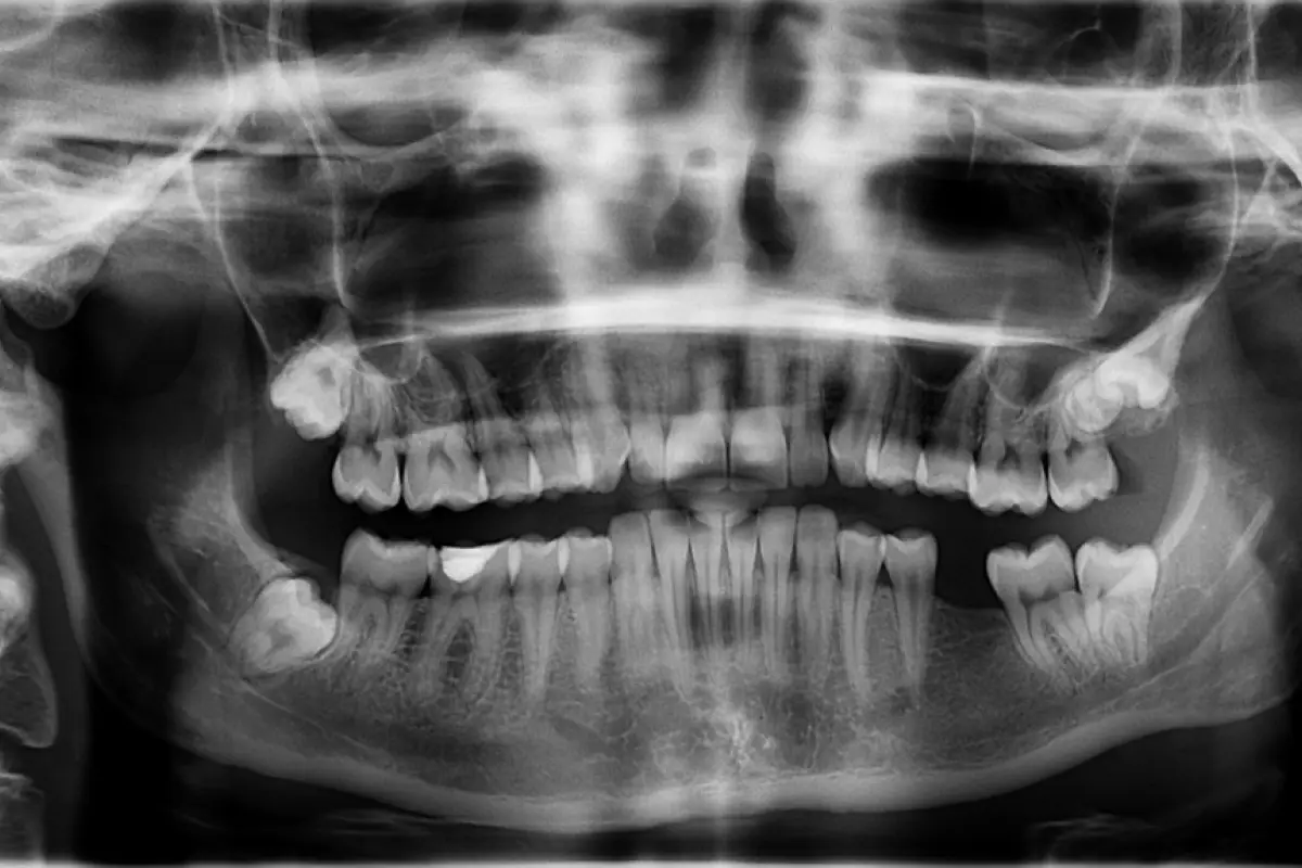 Radiografía dientes. Imagen de referencia. , Pixabay