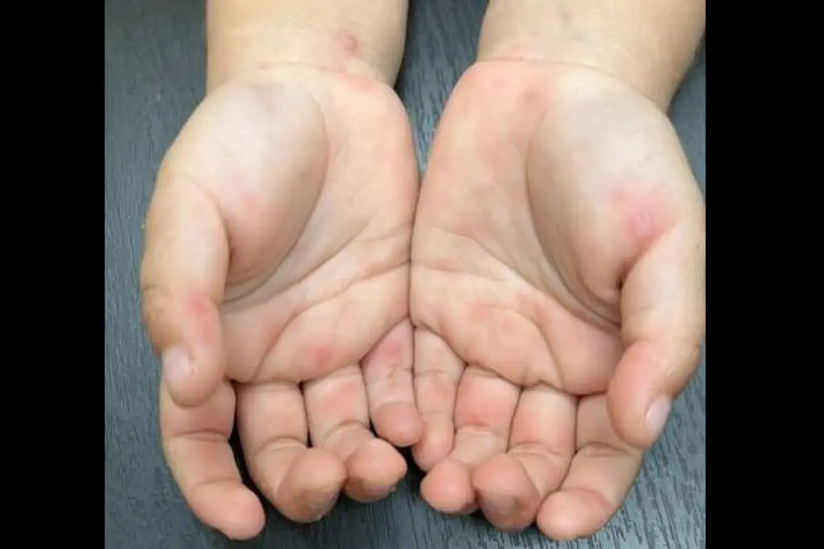 Entre los síntomas del síndrome de manos, pies y boca se encuentran las erupciones en la piel., Ministerio de Salud de Ecuador