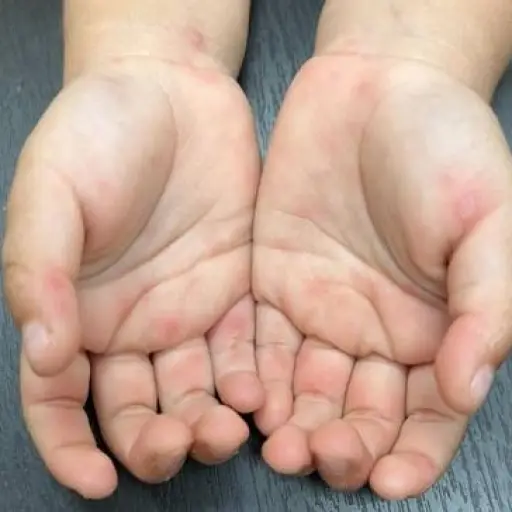 Entre los síntomas del síndrome de manos, pies y boca se encuentran las erupciones en la piel. ,Ministerio de Salud de Ecuador