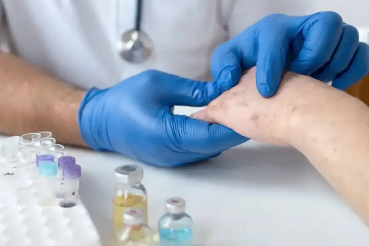 Un paciente evaluado por riesgo de sarampión., Ilustrativa de archivo