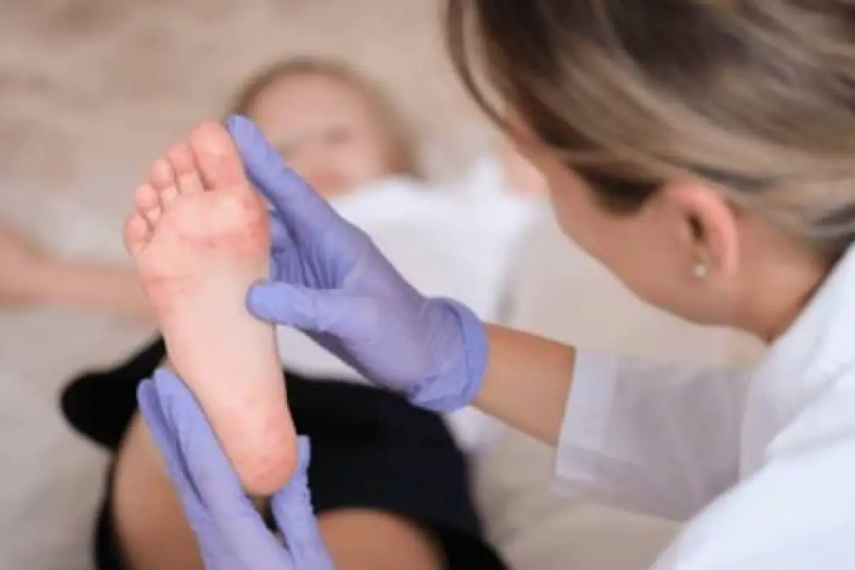 Evaluación a un menor por posibles síntomas de sarampión., Ilustrativa de archivo: EFE