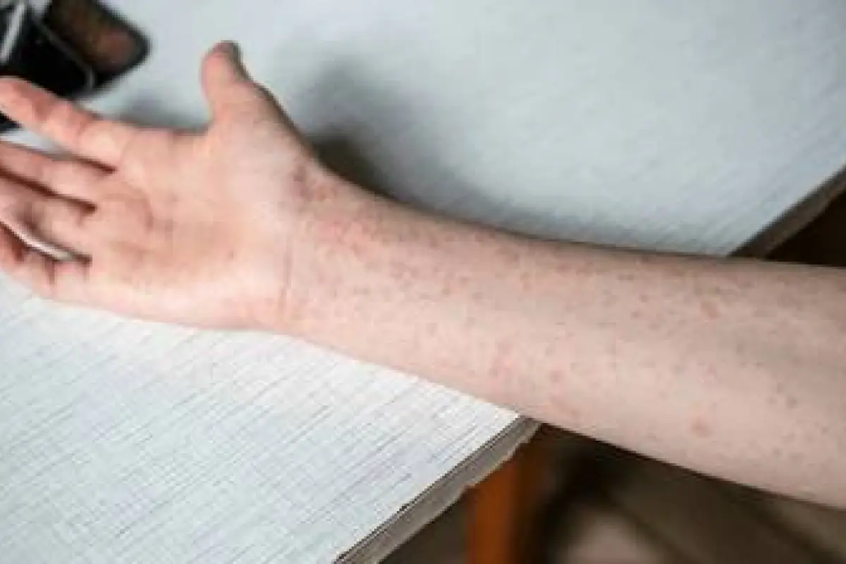 Imagen ilustrativa de una persona afectada por el sarampión., EFE