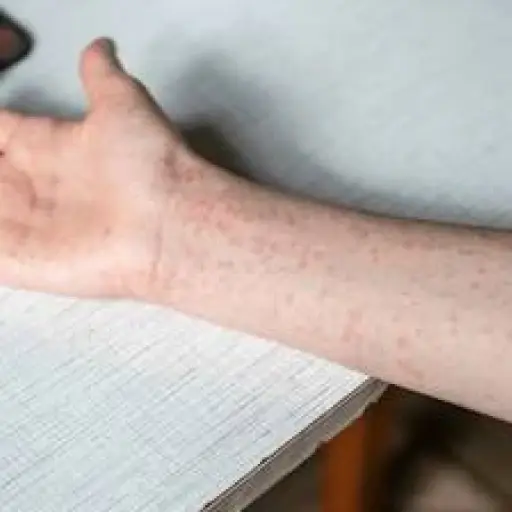 Imagen ilustrativa de una persona afectada por el sarampión. ,EFE